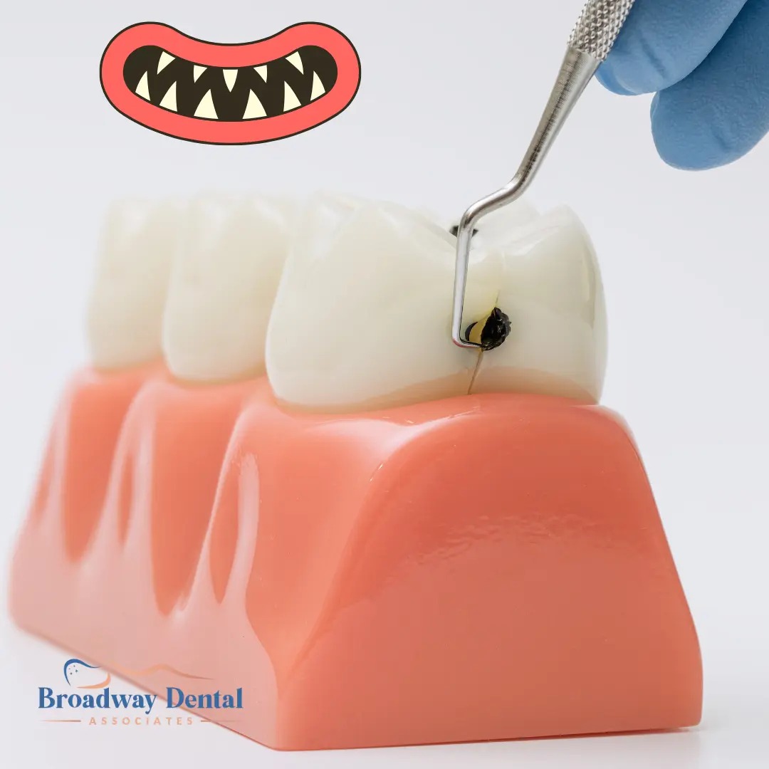Dental tool examining a cavity on a tooth model and Broadway Dental Associates logo in the bottom left of the image